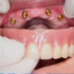 Implantes dentales Palma de Mallorca