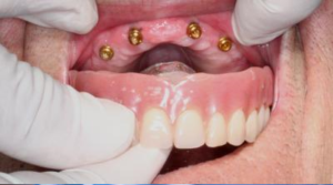 Implantes dentales Palma de Mallorca