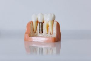 expertos implantes dentales palma mallorca