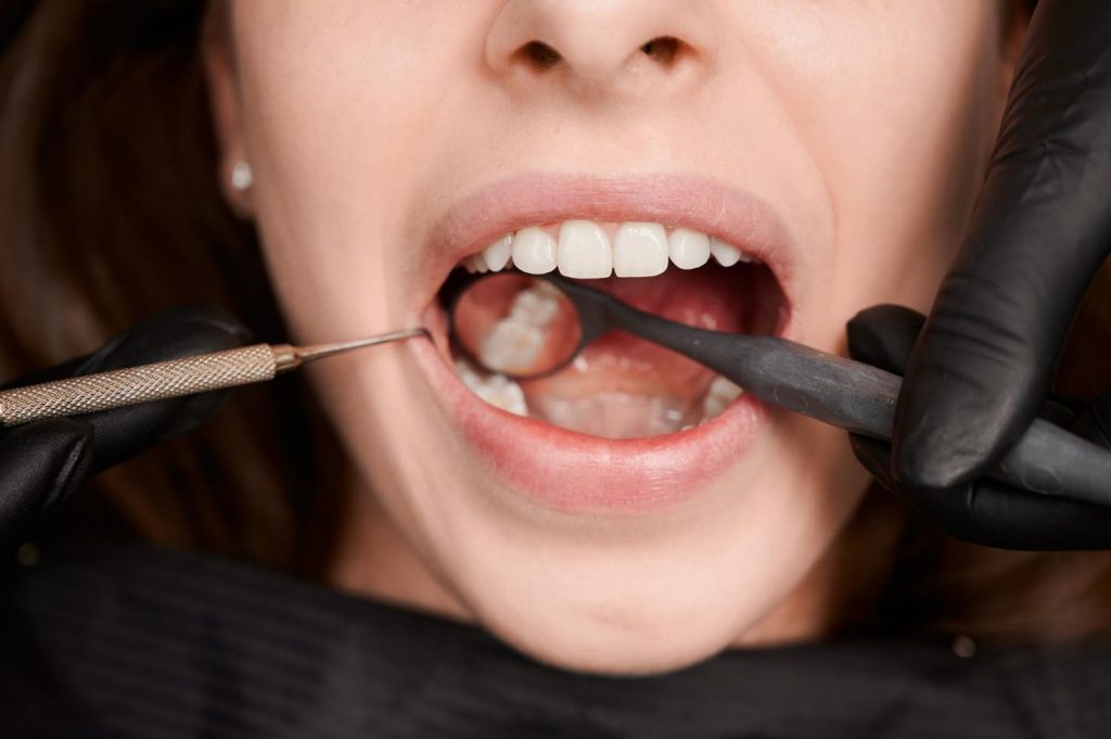 consecuencias de las caries dentales